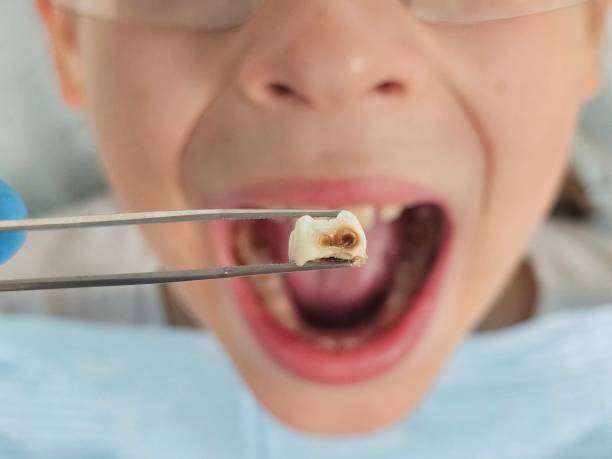 Best Emergency Dentist for Knocked-Out Tooth in Jefferson, TX